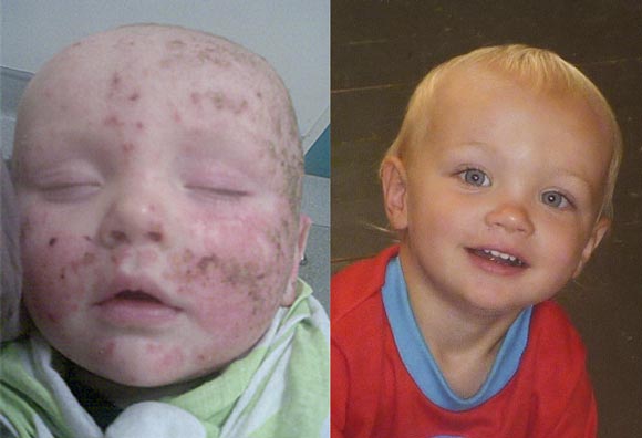 Info: Toby’s Eczema Story