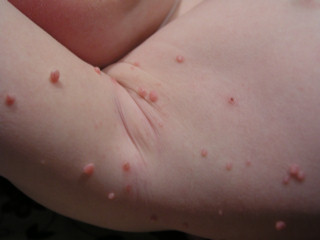 Molluscum contagiosum