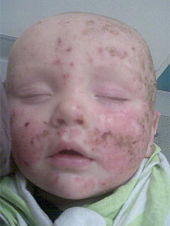 Infected eczema