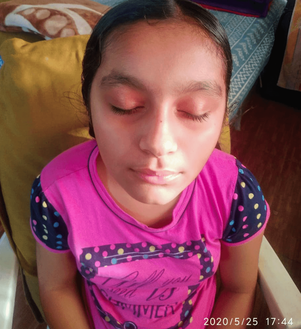 Little girl who now has no vitiligo