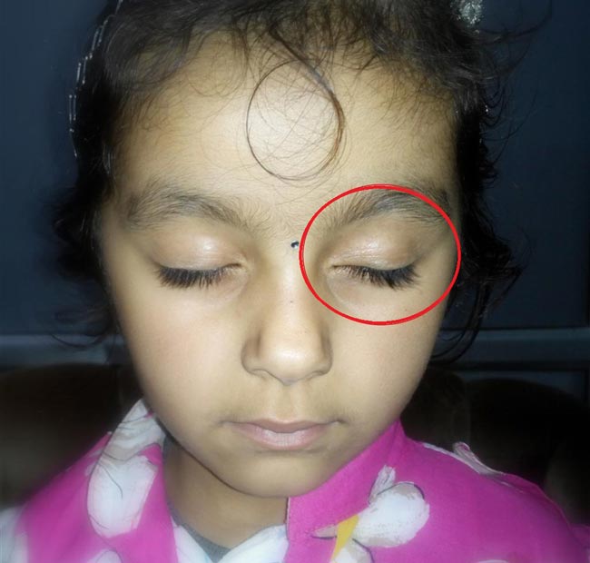 Number 6 four year old girl, case history from Dr Kireet Taneja