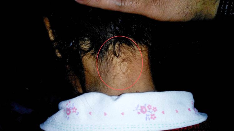 Number 1 vitiligo