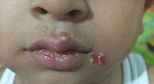 Molluscum contagiosum pictures affect children around the mouth as well as other parts of the body