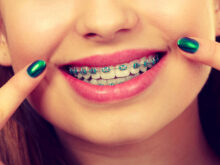 Braces with green fingernails